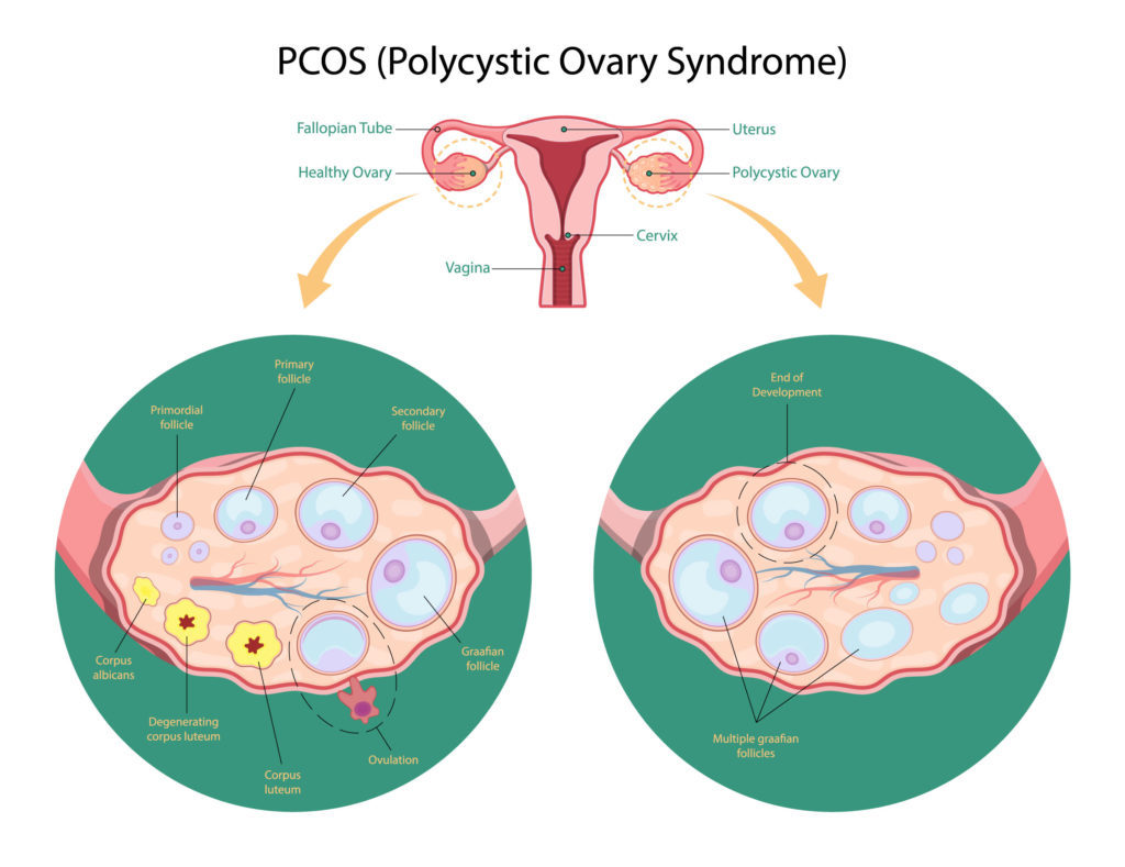 Simptomele bolii ovariene polichistice și relația acesteia cu insulina